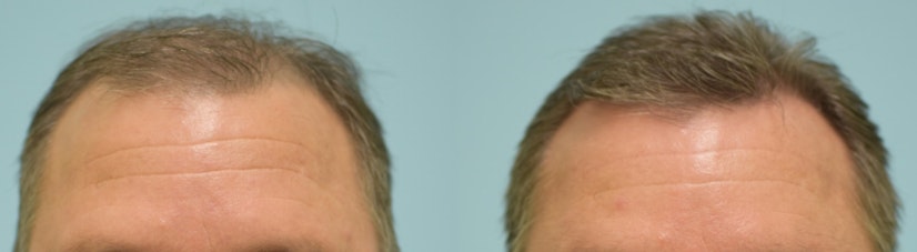 Topical finasteride before and after 4 months photo 2