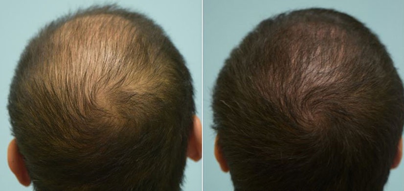Topical finasteride before and after 4 months photo 3