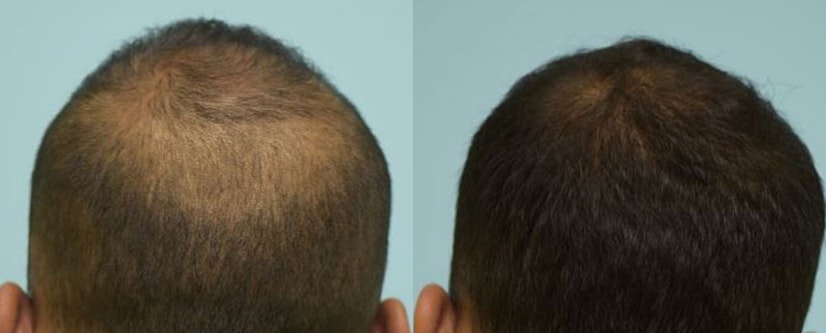 Topical finasteride before and after 4 months