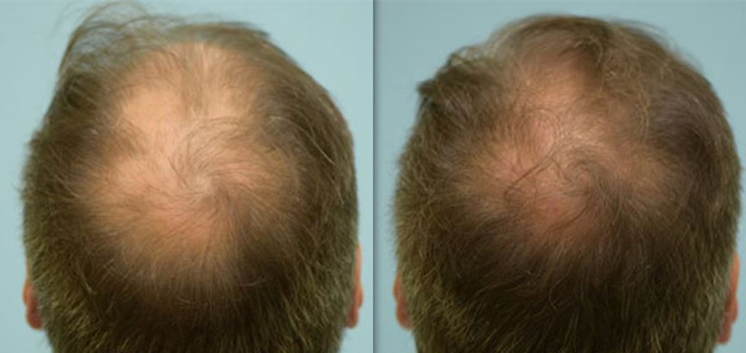 Topical finasteride before and after 5 months photo 2