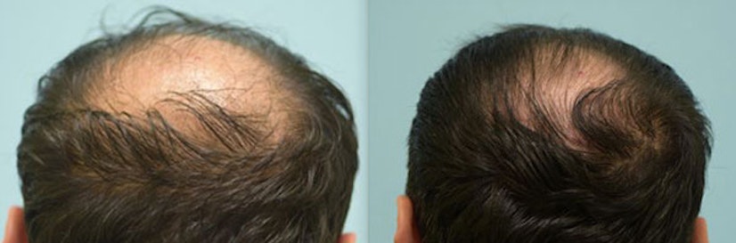Topical finasteride before and after 5 months photo 3