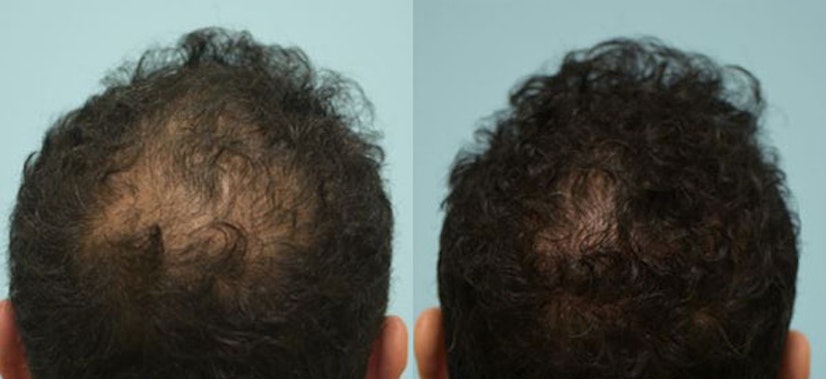 Topical finasteride before and after 5 months