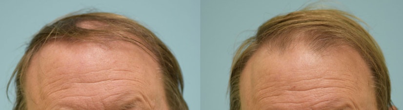 Topical finasteride before and after 6 months photo 2