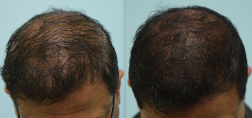 Topical finasteride before and after 6 months photo 3