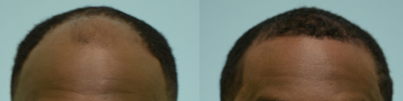 Topical finasteride before and after 6 months