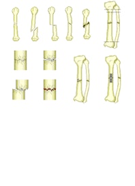 Different Types of Bone Fractures